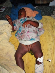 Baby with malaria and an Hb of 2