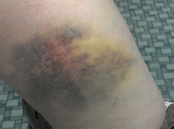 bruise like spot