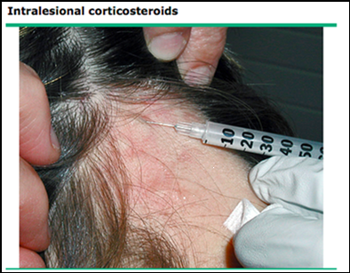 Steroid shots in scalp for hair.loss
