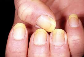 Photos Of Yellow Nail Pictures Images Photo
