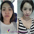 View Plastic Surgery Korea - "I was a country girl..." Before & After (Nano Bimaxillary osteotomy)