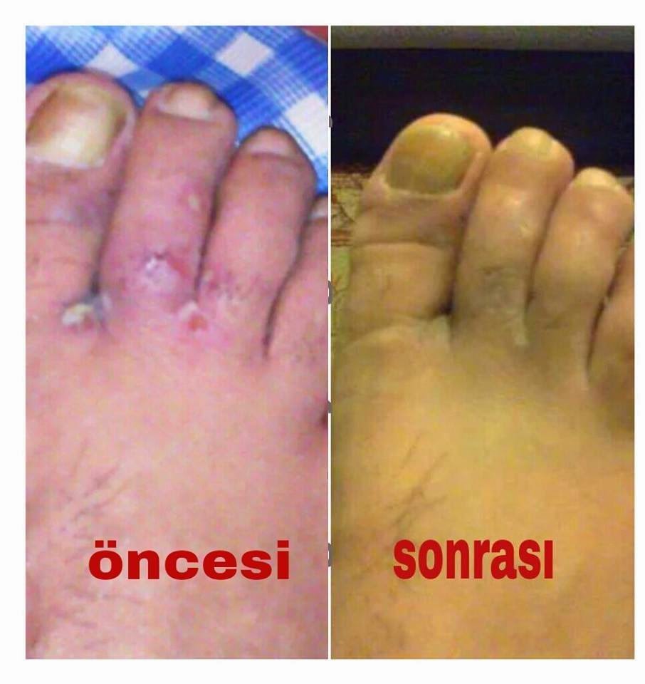 Ersağ Ayak Bakım Ürünlerini Kullananların Aldığı Sonuç