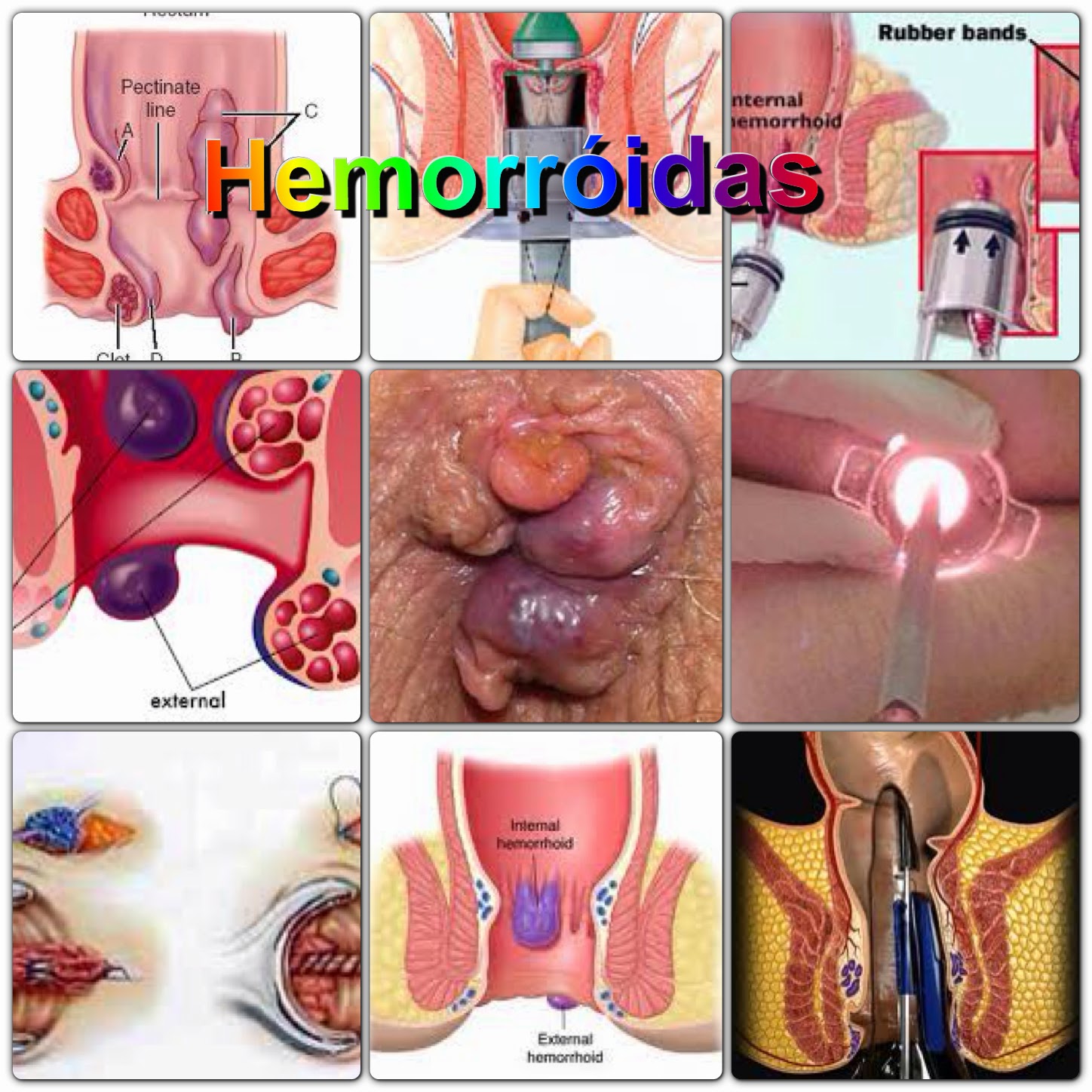 hemorroidas-1.jpg