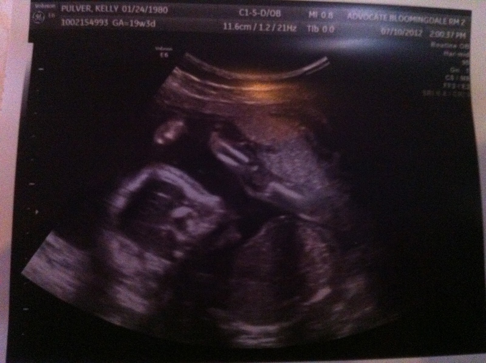 Baby Pulver!!! 19 week Level 2 Ultrasound