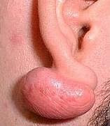 fotos de Piercing Inflamado imagens de Piercing Inflamado