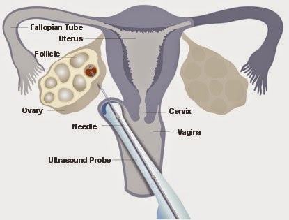 Direct oocyte sperm transfer