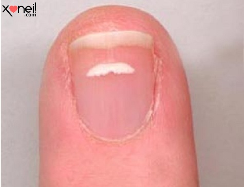 O que são essas manchas brancas que aparecem nas unhas? Tirinha Gordo Fresco: O que são essas manchas brancas que aparecem nas unhas?