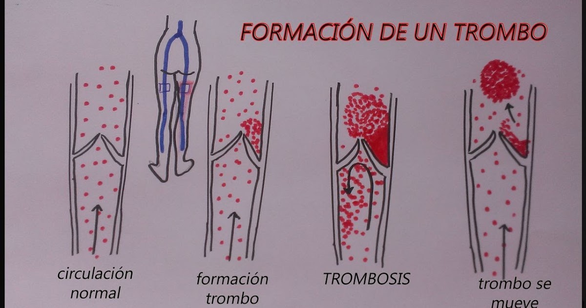 Cuidando prótesis mitral ¿QUÉ DIFERENCIA HAY ENTRE TROMBOSIS Y EMBOLIA?