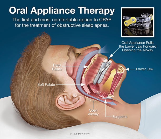Sleep Apnea Oral Device Reviews 15