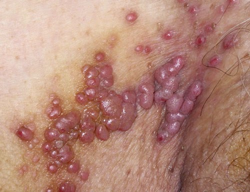 Penyakit Herpes Pada Kelamin Penyakit Herpes Pada Kelamin