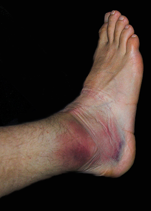 Ankle Sprain Treatment For Athletes