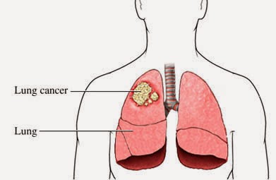 types causes and treatments for lung cancer Start here for information on common types of cancer, including breast, lung, colon, skin, prostate, and ovarian cancer get the facts on cancer symptoms, treatments. types causes and treatments for lung cancer Start here for information on common types of cancer, including breast, lung, colon, skin, prostate, and ovarian cancer get the facts on cancer symptoms, treatments.