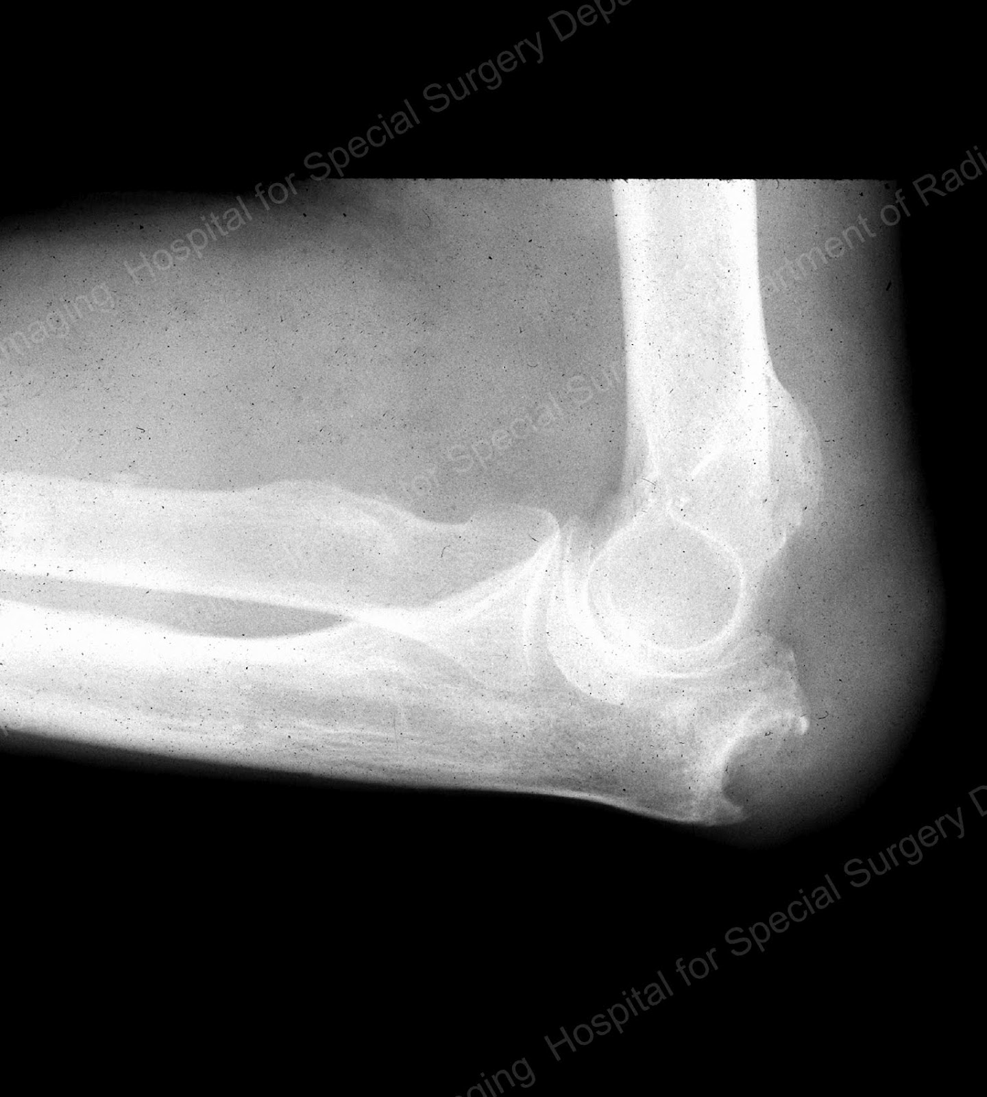 case press gouty arthritis 2012 american college of rheumatology acute gouty arthritis logic ult in a range of case scenarios of patients with. case press gouty arthritis 2012 american college of rheumatology acute gouty arthritis logic ult in a range of case scenarios of patients with.