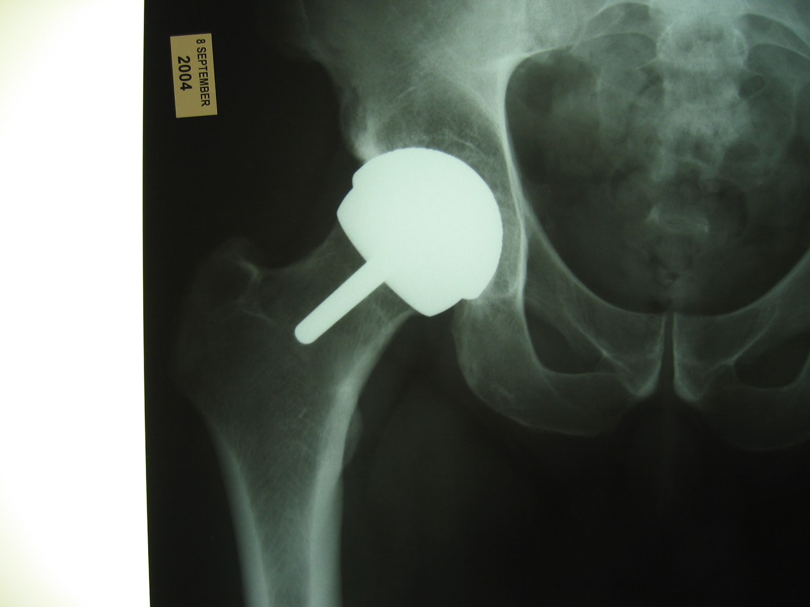 Tom's Physiotherapy Blog Surgery to the Hip