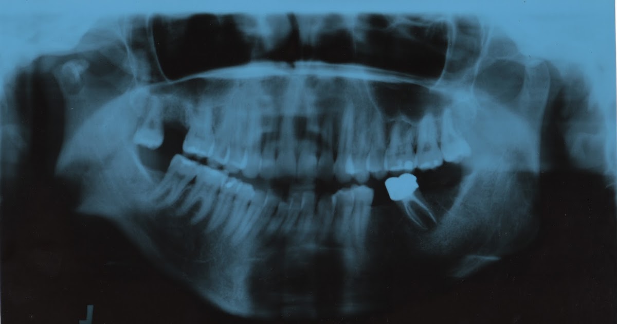 Icd Code For Xray Of Jaw To Detect Metal