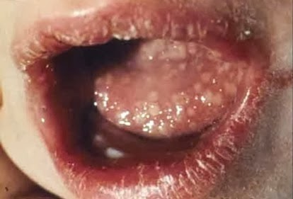Herpes Mulut Herpes Mulut