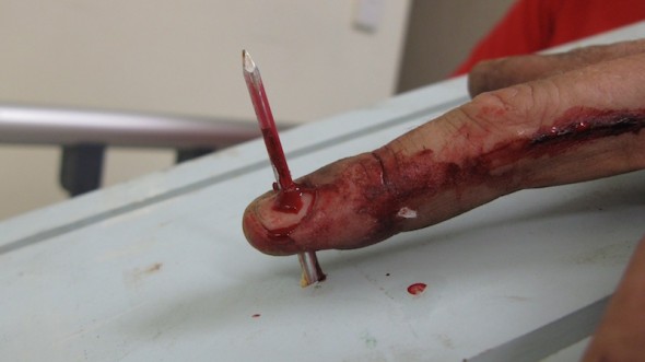 Hand Injured