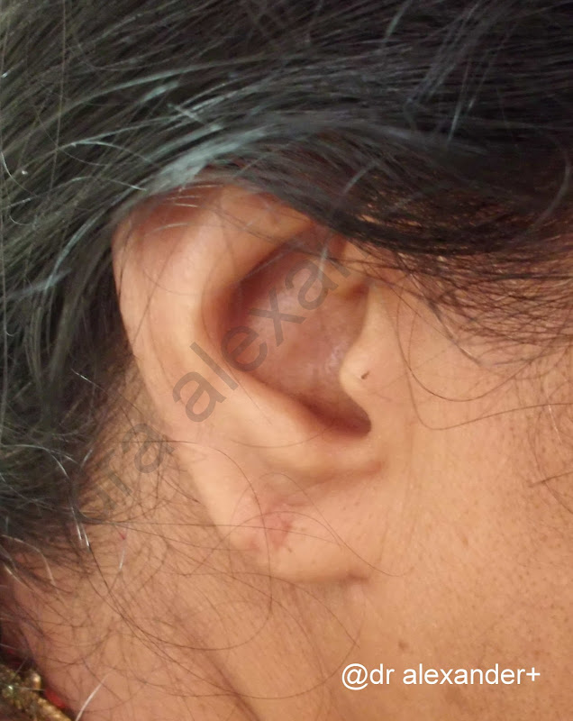 Face burns, plastic surgery, cosmetic surgery, Dr Alexander, plastic title=