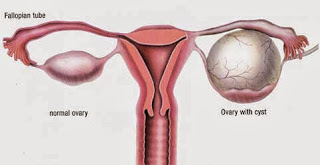 Ovarian Cyst Explanation of Ovarian Cyst for women