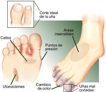 Los baños sódicos para los pies el hongo de la uña