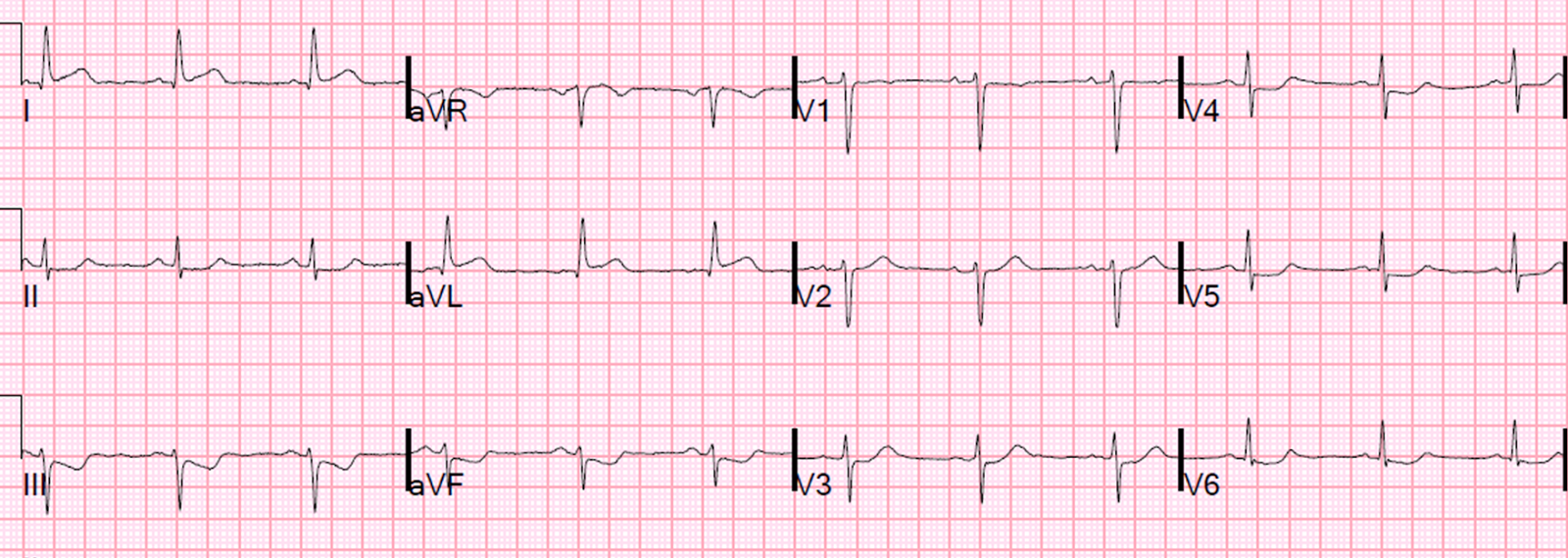 Dr. Smith's ECG Blog True Positive ST elevation in aVL vs. False
