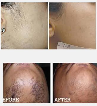 Natural Permanent Hair Removal 08152054136 Natural Permanent
