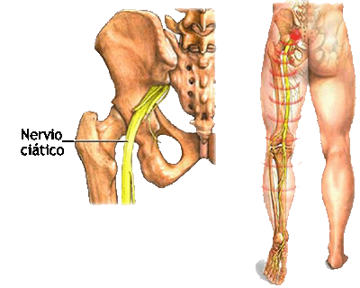Como llevar correctamente el cuello de la trinchera por el adulto a la osteocondrosis