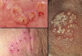 penyakit herpes obat herpes