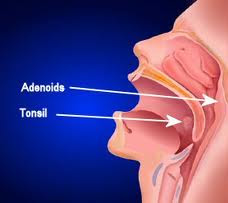 Herbal Indonesia amandel, gejala amandel, penyebab amandel, mencegah amandel, ramuan amandel, AMandel