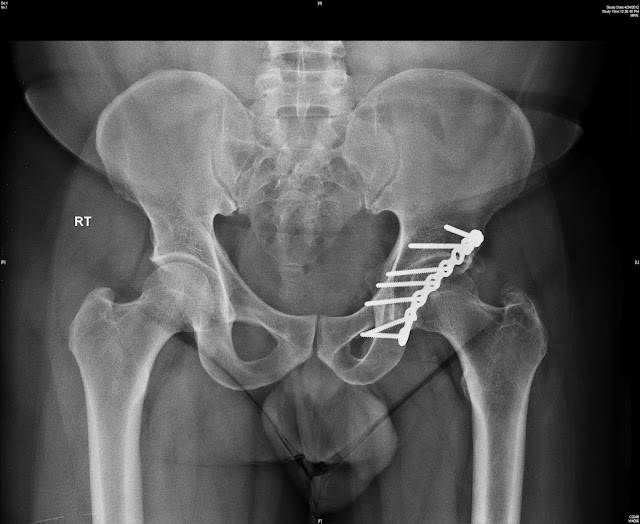 Acetabular Reconstruction
