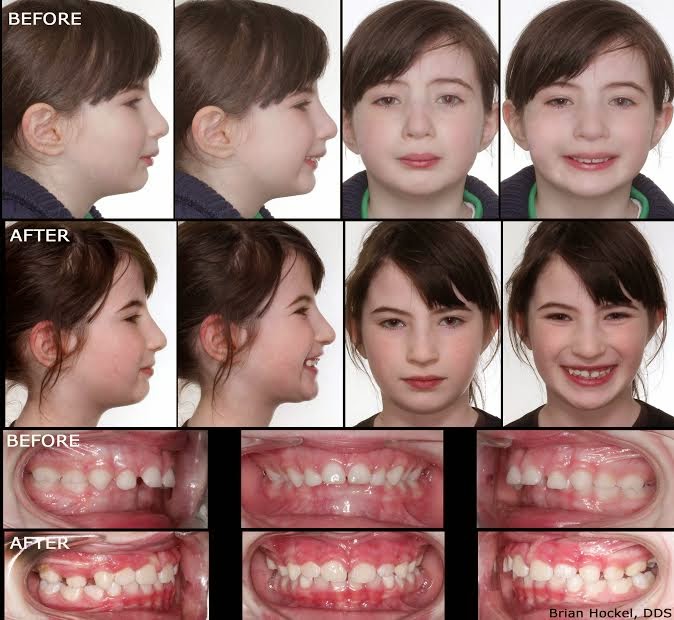 Nourished and Nurtured Changing Facial Growth by Changing Oral Posture