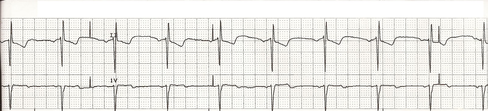 pacemaker failure to capture rhythm strip