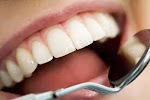 Dental Implants In Guelph