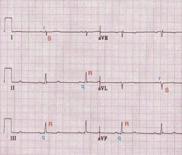 Left Posterior Fascicular Block INA ECG