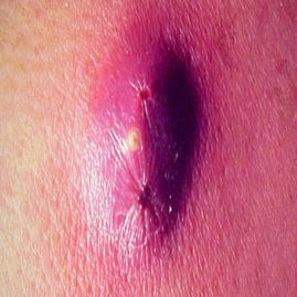 Mengatasi Bisul Secara Alami