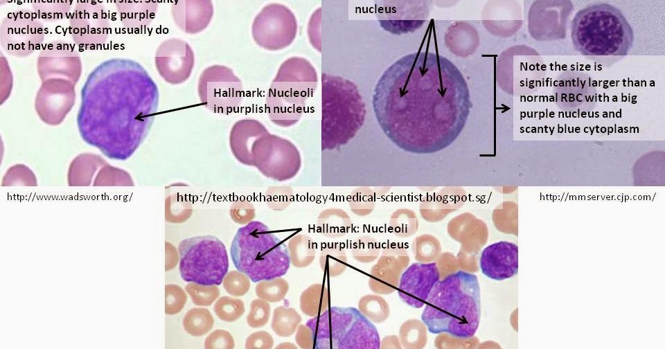 Haematology in a NutShell Immature Granulocytes in PBFs