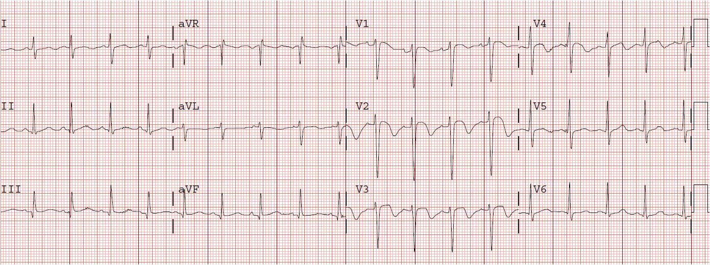 Pe On Ecg