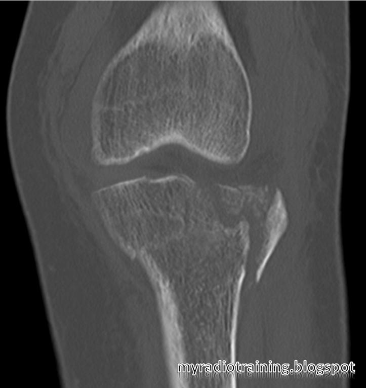 Radiology info hub: Proximal tibial fracture - Schatzker Classification
