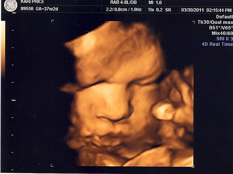 Sex of baby ultrasound pictures