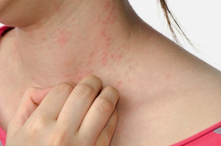 MẸO TRỊ DỊ ỨNG ĐƠN GIẢN, NHANH NHẤT MẸO TRỊ DỊ ỨNG ĐƠN GIẢN, NHANH NHẤT