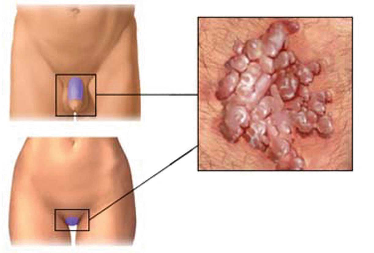 HPV nedir HPV nedir