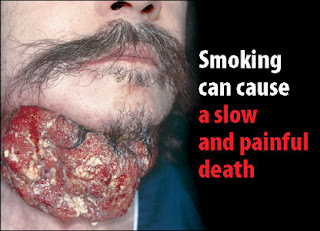 Cancer because Smoking