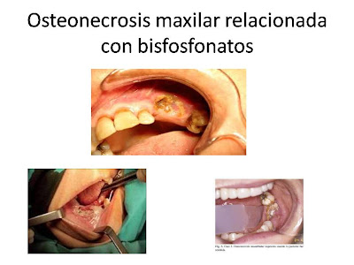 Osteonecrosis maxilar