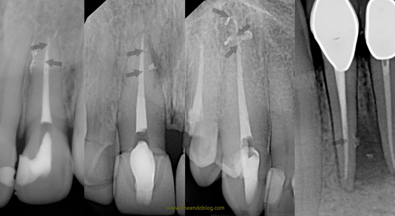The Endo Blog The Buzz About Endodontic Irrigation