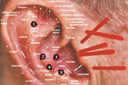 Auricular Acupuncture