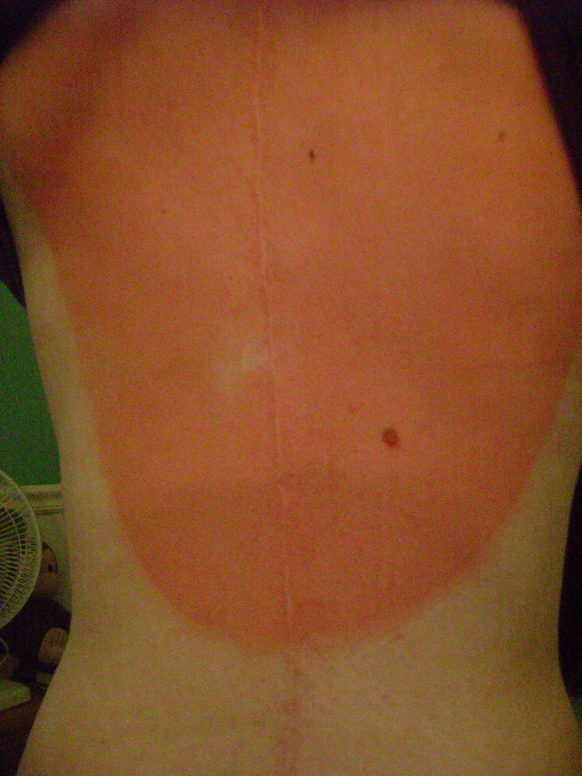 Sunburn Scars