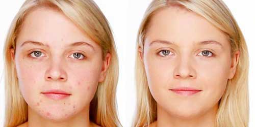 maquillaje antes y despues acne