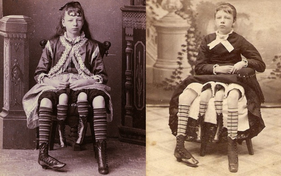 Josephine Myrtle Corbin: conheça a história da mulher com quatro pernas
