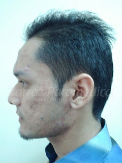 masalah jerawat azizol zarraz paramedical, masalah jerawat azizol, rawatan jerawat muka, cara menghilangkan jerawat, rawatan jerawat resdung, rawatan untuk jerawat, rawatan laser jerawat, rawatan parut jerawat, rawatan jerawat batu, rawatan tradisional jerawat,tips masalah jerawat