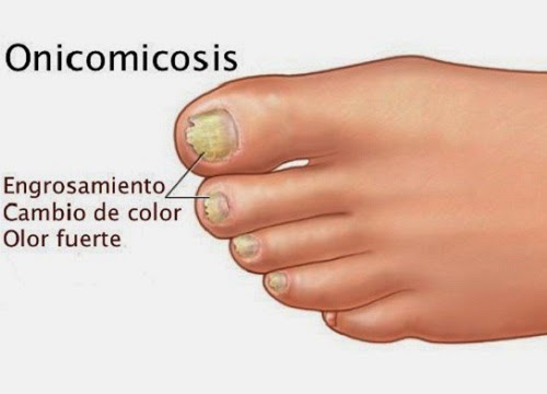 El hongo de la piel de los dedos de las manos cerca de las uñas